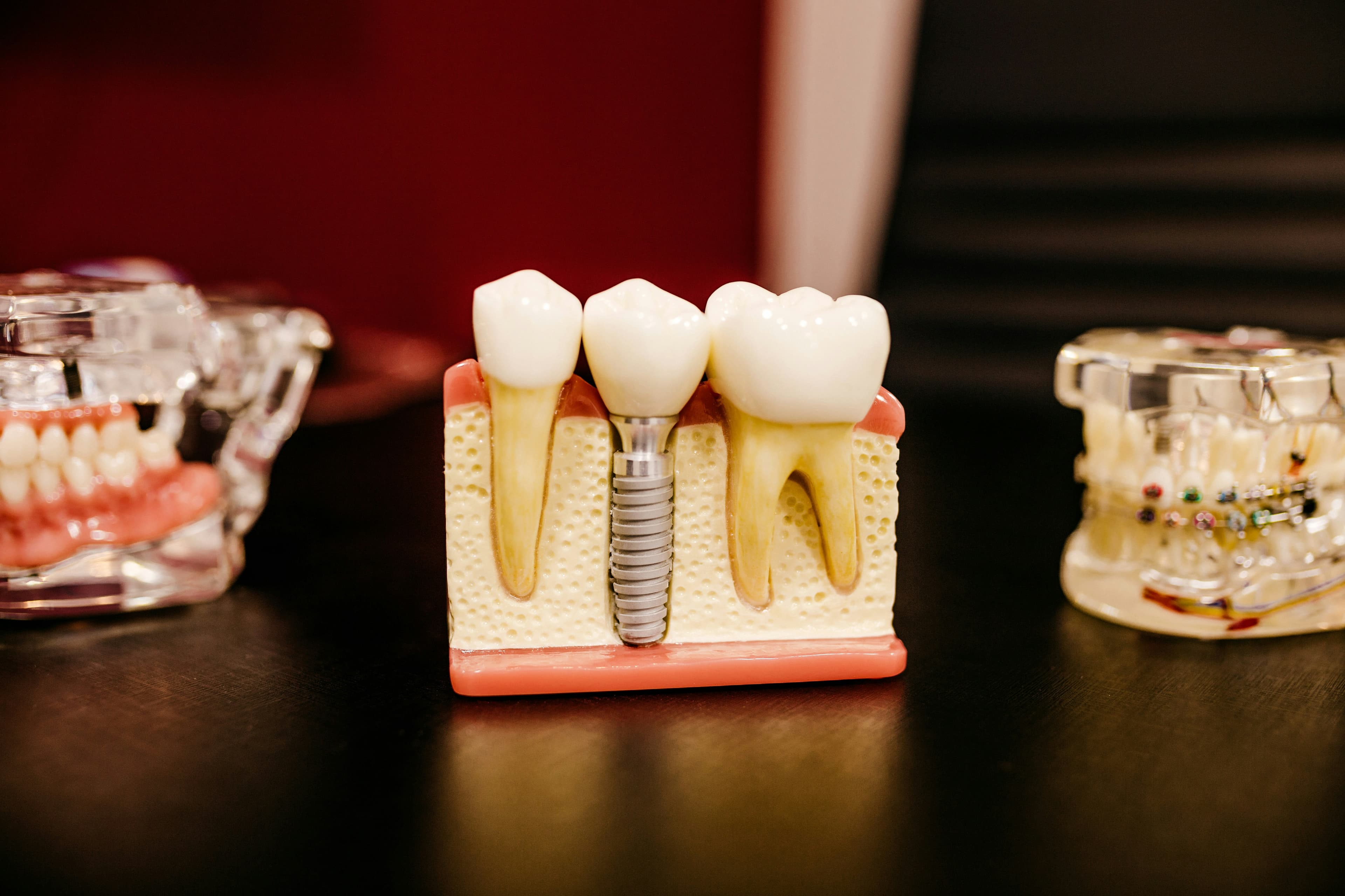 Mô hình implant nha khoa